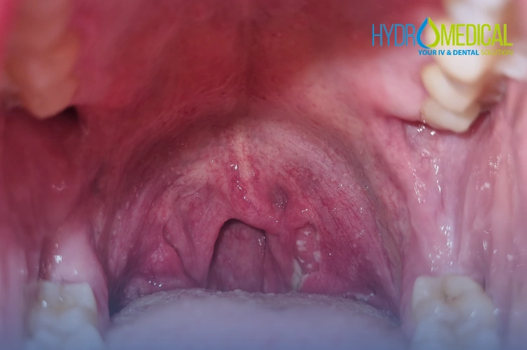 ENT doctor in Bali diagnosing a throat infection (tonsillitis).