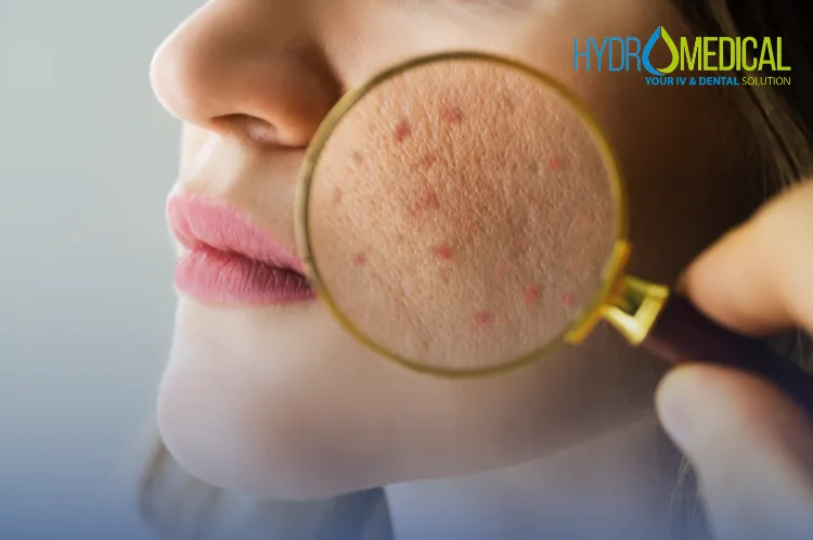 Professional acne and scar treatment options available at Hydro Medical Clinic Bali.