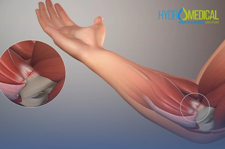 Golfer's elbow medial epicondylitis treatment for Padel players in Bali.