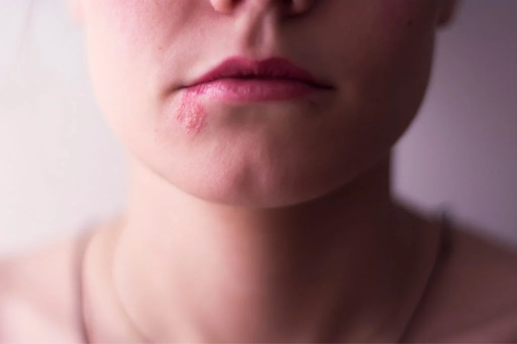 A woman having a Herpes on the corner of the mouth