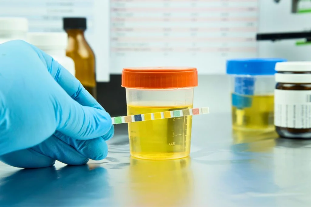 A clean urine sample at a Bali clinic, ready for testing for both UTI and STDs.