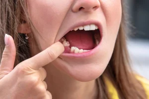 Identifying the long-term risks of a missing tooth gap.
