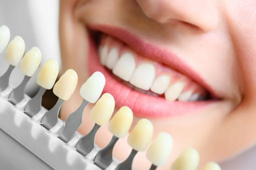 Precision shade matching for composite and porcelain veneers.