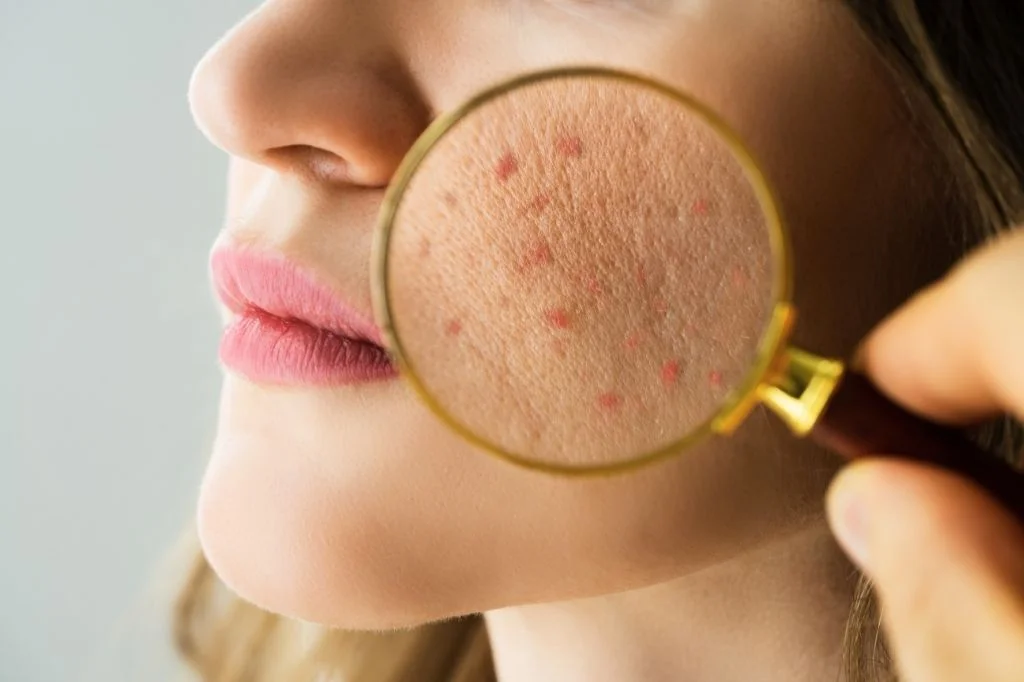 Dermatologist examining the acne in tourist skin