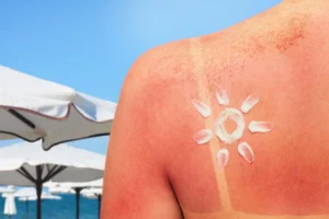 Tourist applying aloe or aftersun care to a sunburned shoulder in Bali