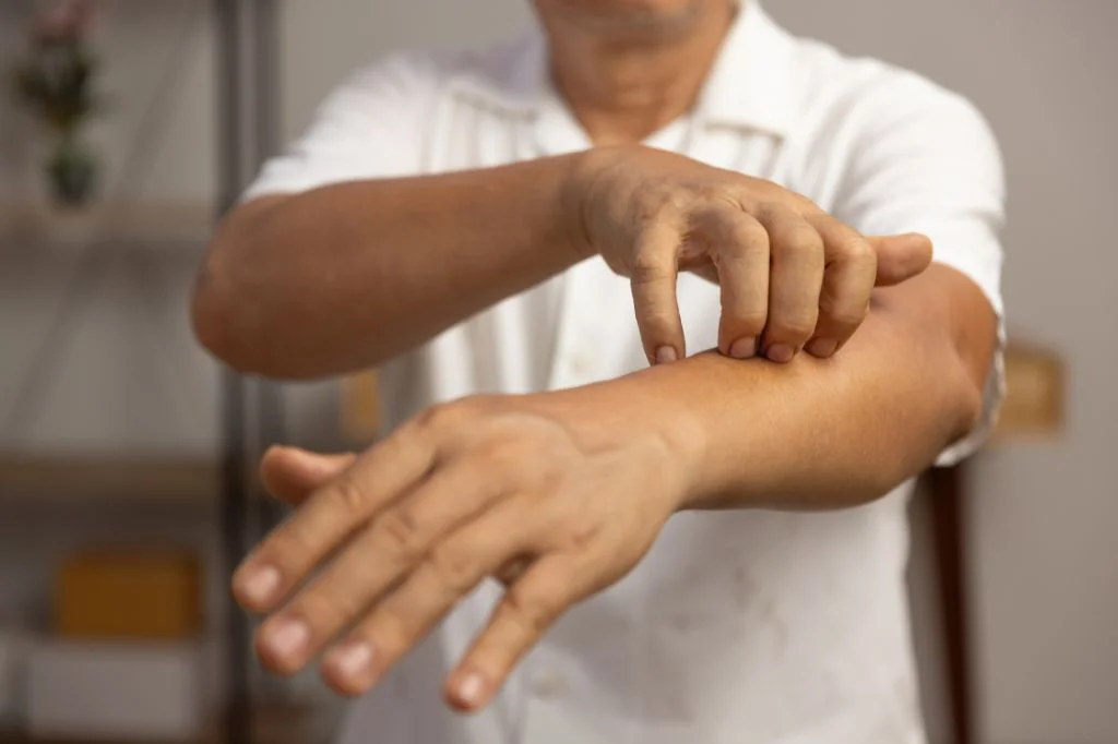 A tourist scratching on a hives, a sign of an emergency