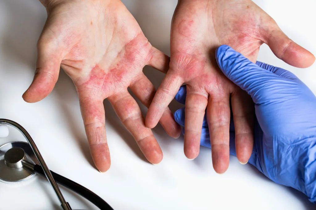 Dermatologist preparing to perform a skin allergy test on a patient's forearm in a Bali clinic